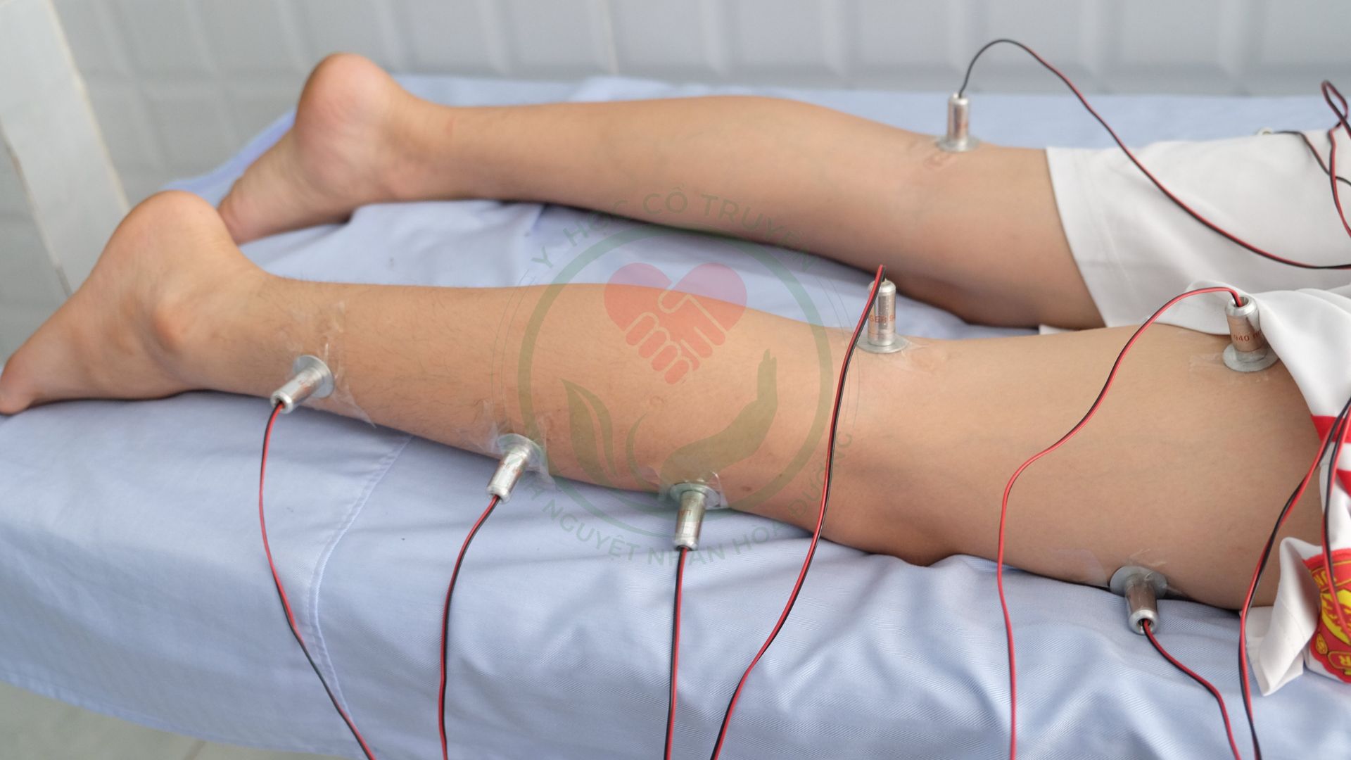 Châm cứu Laser Quang châm Quang trị liệu - Giải pháp dành cho người bệnh sợ kim, sợ đau