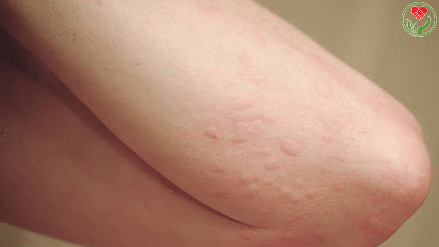 bệnh nổi mề đay