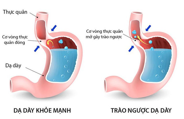 mô tả bệnh trào ngược dạ dày thực quản
