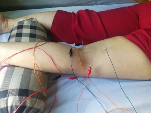 Châm cứu chữa bệnh điện châm tại phòng khám đông y Minh Nguyệt Nhân Hoà Đường