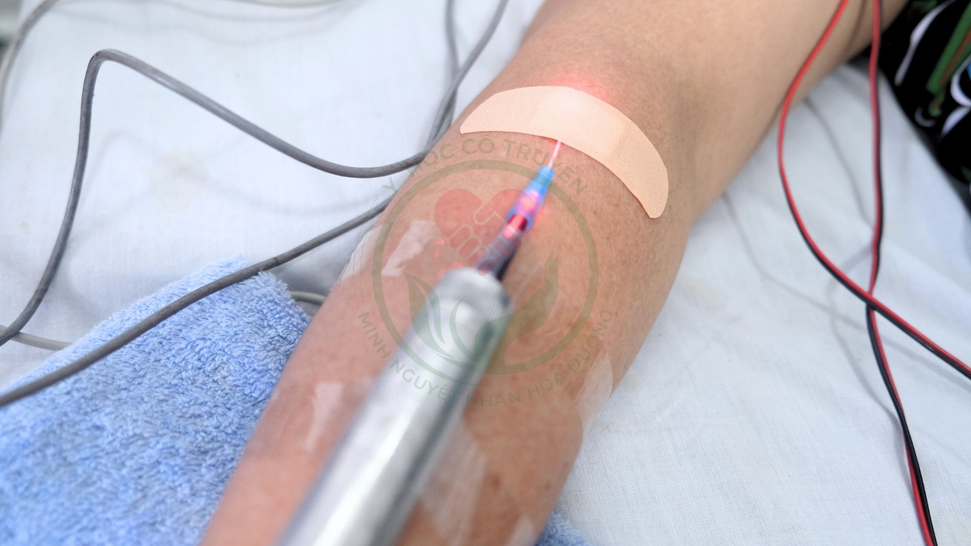Dieu-tri-Laser-ban-dan-cong-suat-thap-Noi-tinh-mach-tai-Phong-kham-Dong-y-Minh-Nguyet-Nhan-Hoa-Duong