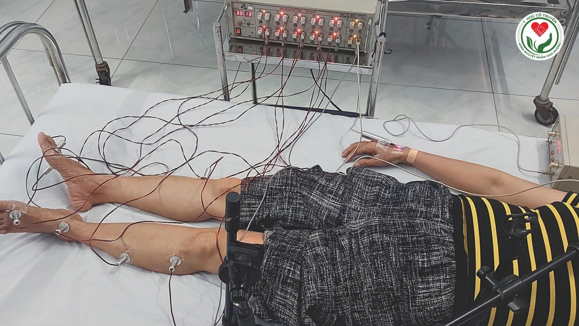 Điều trị bệnh nhân Giãn tĩnh mạch bằng Quang châm Quang trị liệu Laser bán dẫn công suất thấp