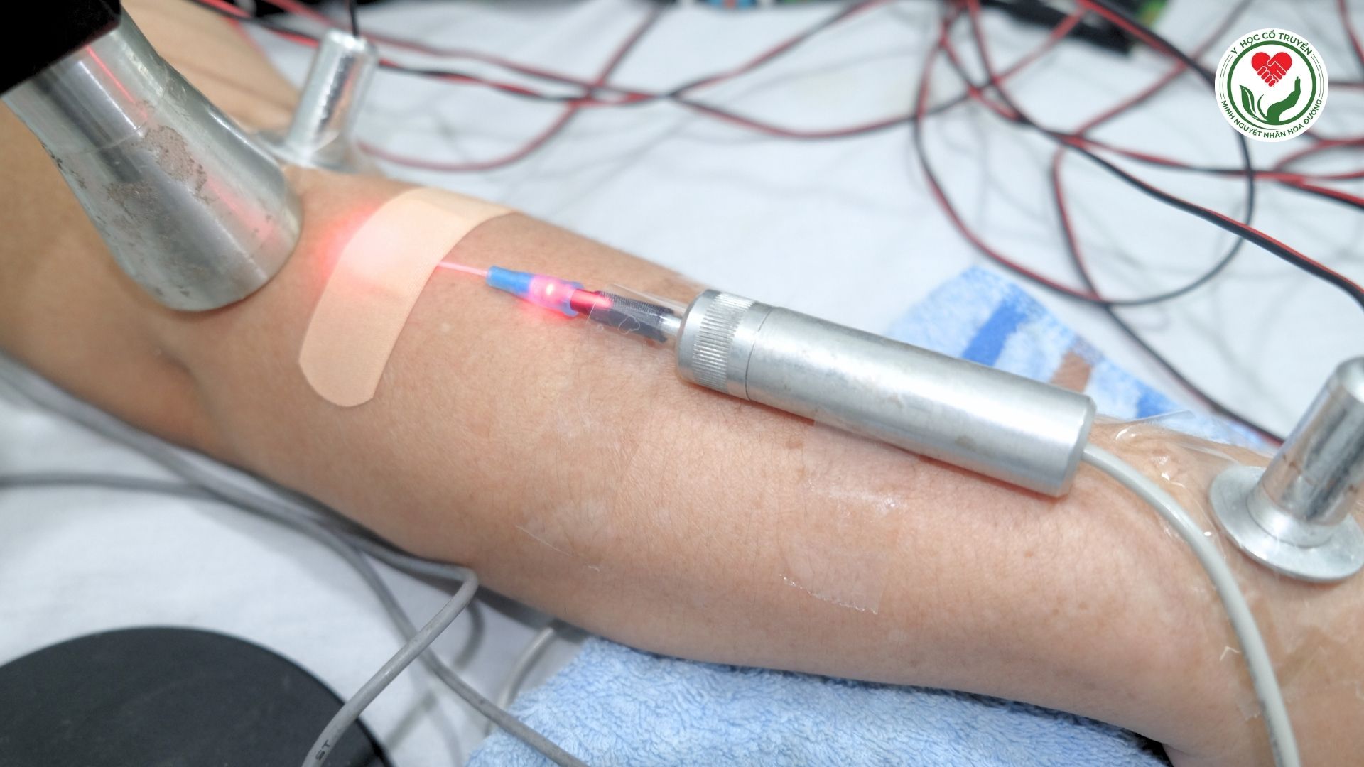 Phương pháp Laser bán dẫn công suất thấp Nội tĩnh mạch