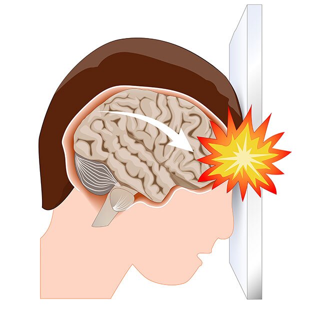 Di chứng chấn thương sọ não
