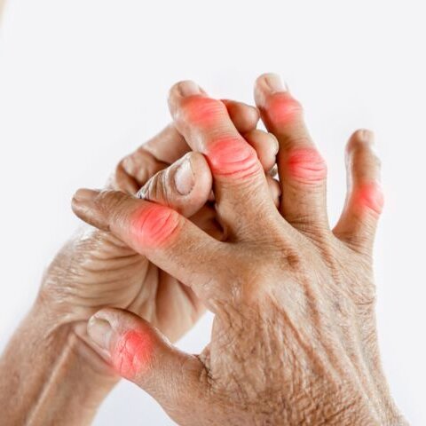 Viêm khớp dạng thấp